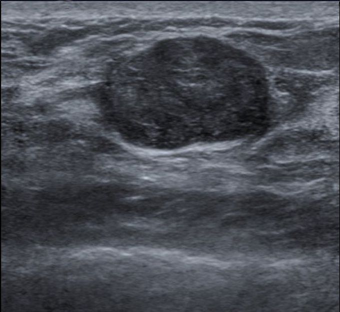 Fibroadenoma of the Breast