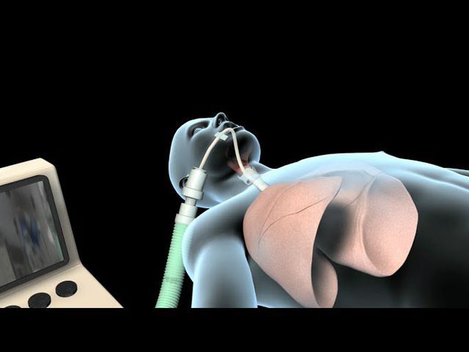 Intubation & Mechanical Ventilation