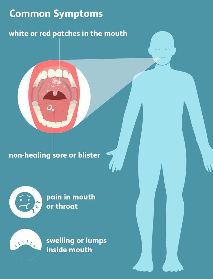 Symptoms of Oropharyngeal cancer