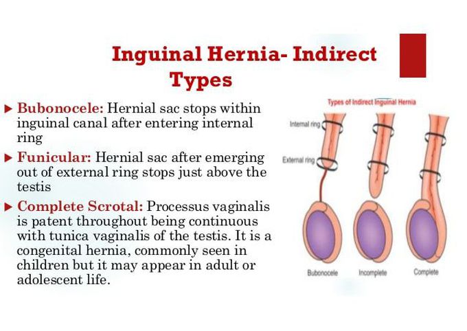 Classification of Indirect Inguinal Hernia