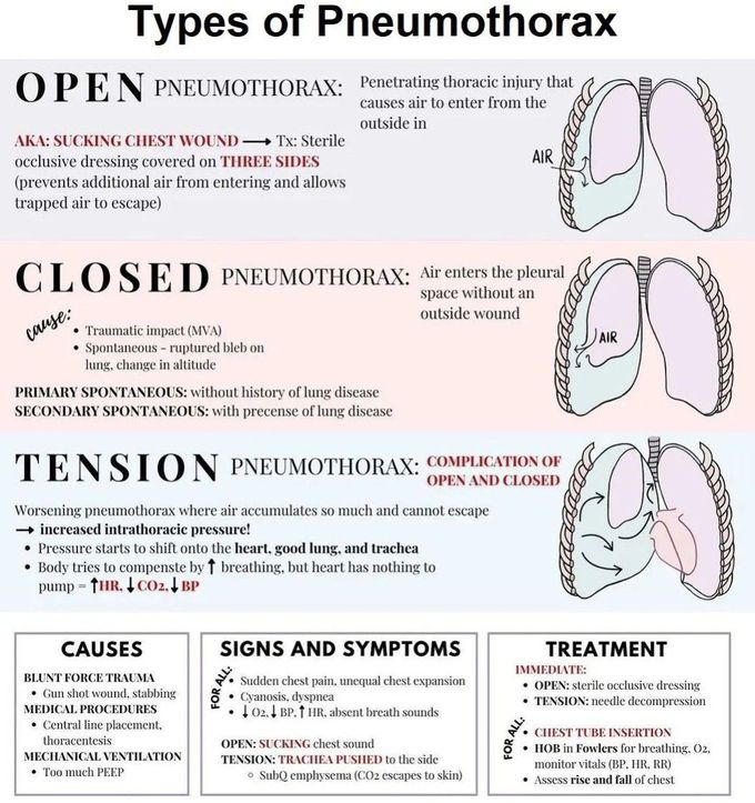 Types of Pneumothorax