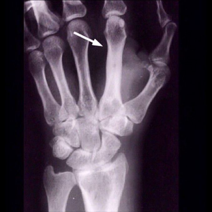 Osteomyelitis of the second metacarpal