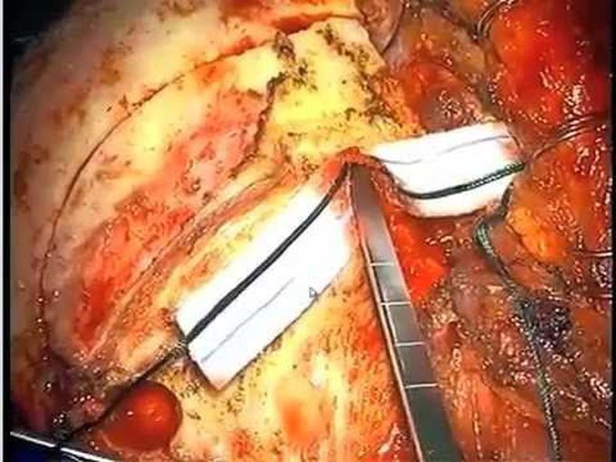 Intra-Orbital Meningioma-Resection through Modified Orbitozygomatic Craniotomy