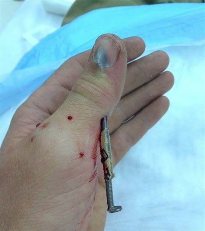 Nail gun accident! 