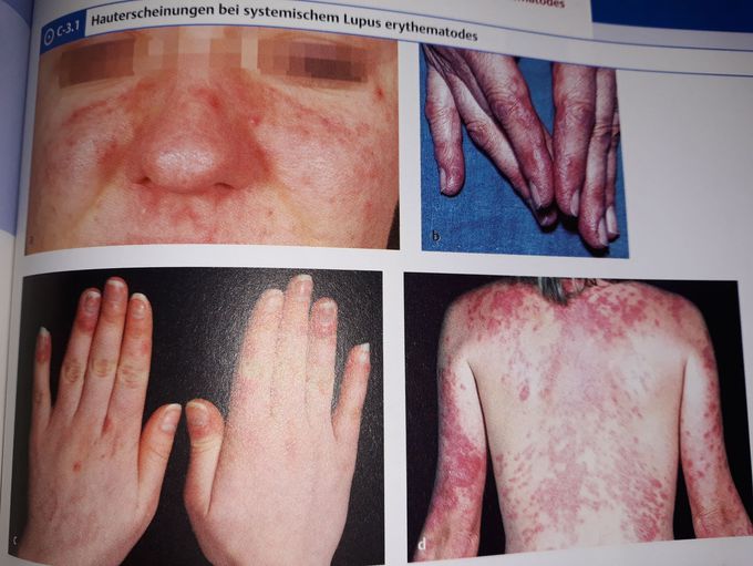 systemic lupus erythematosus