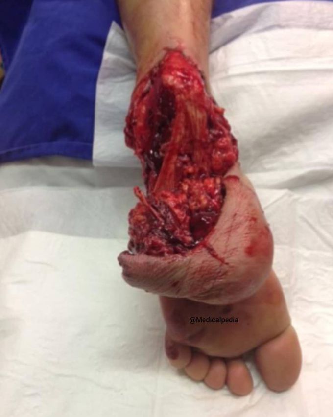 Heel pad avulsion