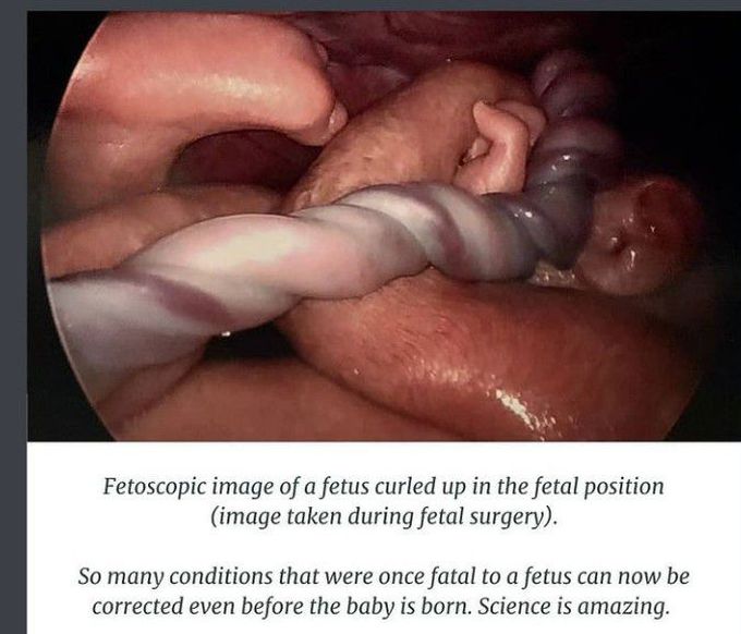 FETOSCOPIC IMAGE
