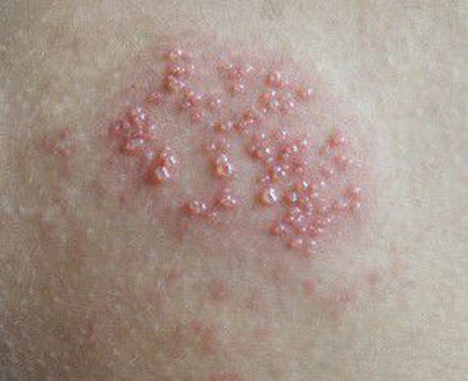 Genital herpes
