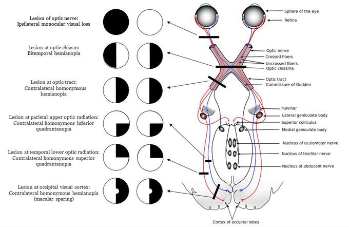 Lesions do optic nerve