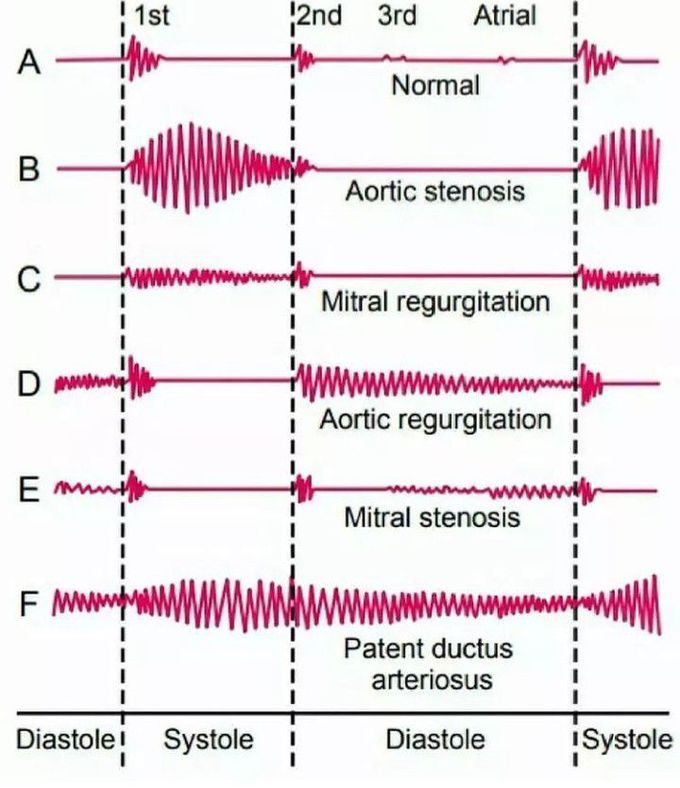 Phonocardiograms