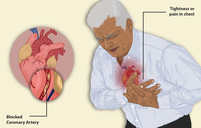 Stable angina pectoris
