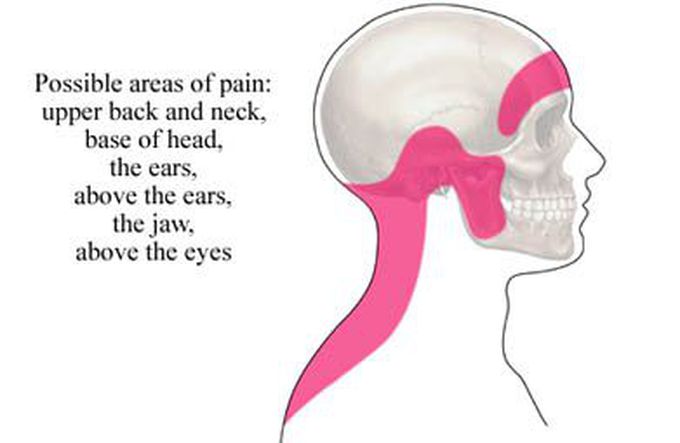 Tension headache