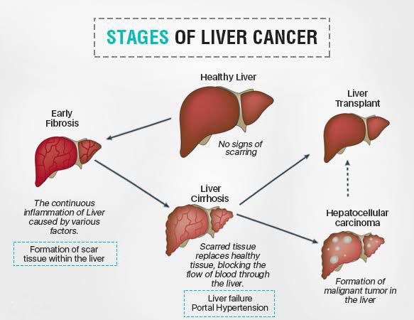 These are the stages of Liver cancer - MEDizzy