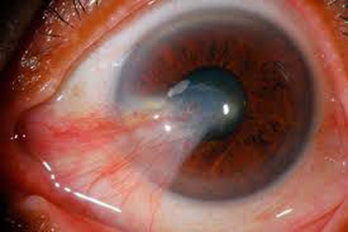 Pterygium sings and symptoms