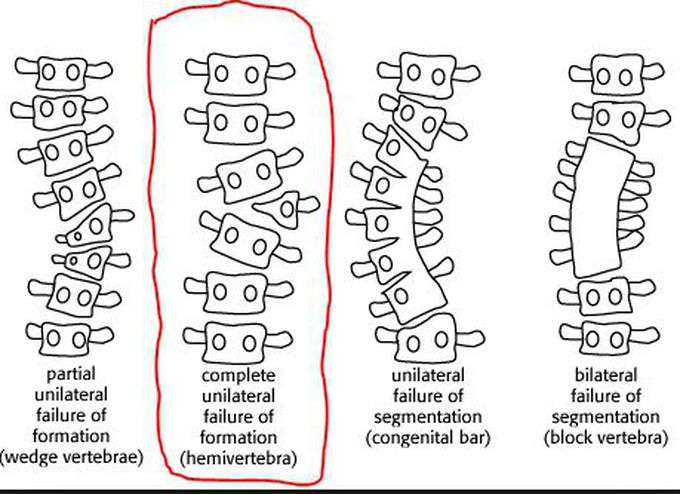 Congenital deformities of the spine