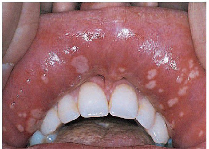 Recurrent aphthous stomatitis, herpetiform type.