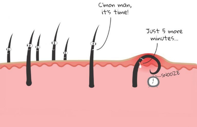 Management of ingrown hair