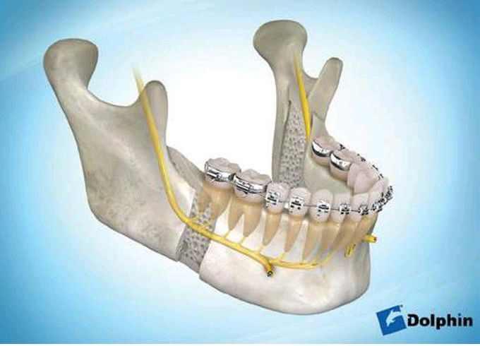 Sagittal split osteotomy