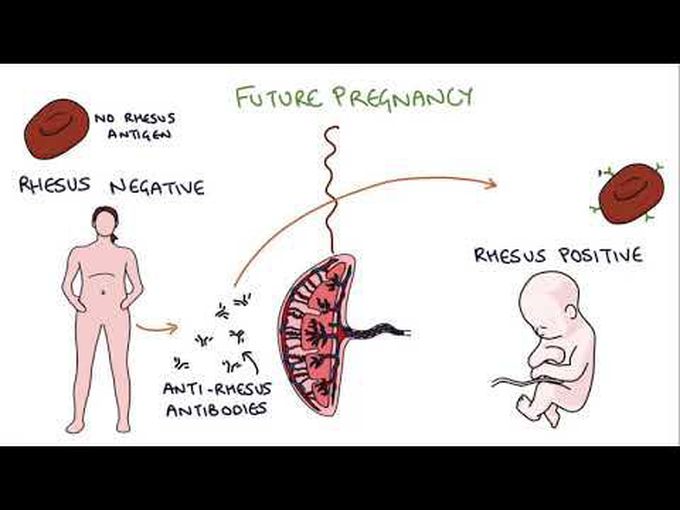 Anti-D in Pregnancy