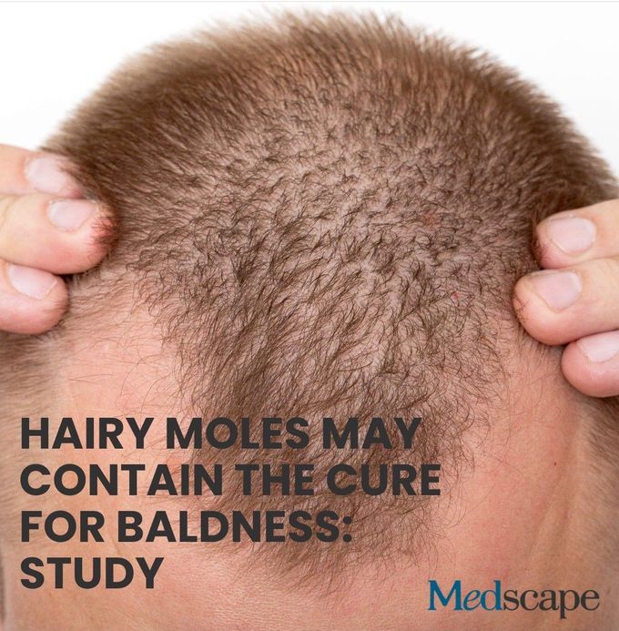 Hairy Moles And Baldness