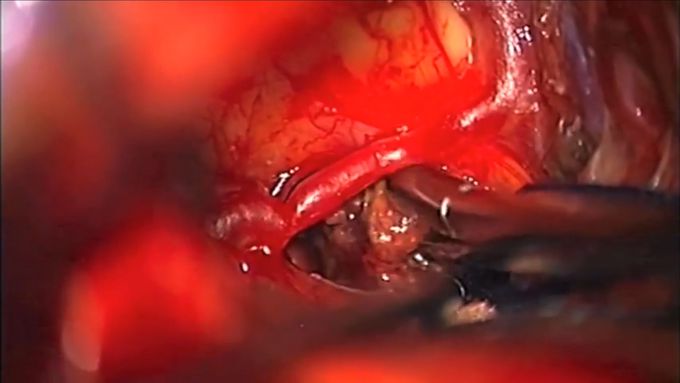 Neurosurgery