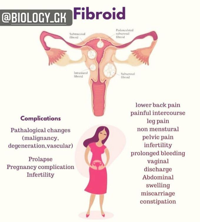 Uterine fibroids- symptoms and complications