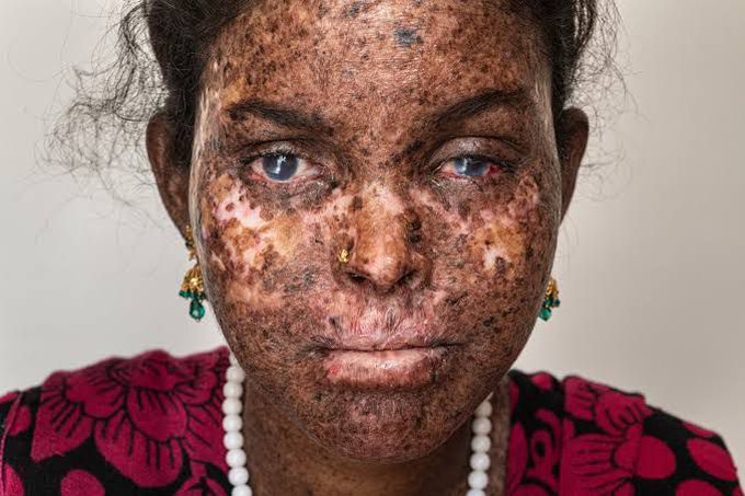 Xeroderma pigmentosum