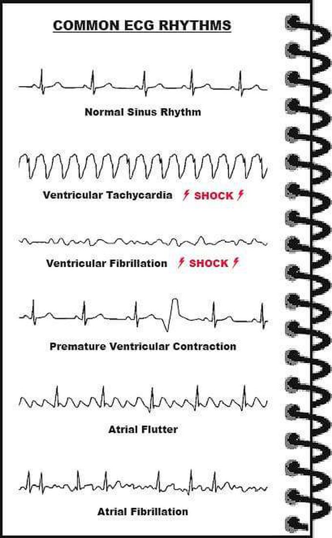 A Normal Ecg Is Illustrated Above Note That The Heart Is Medizzy