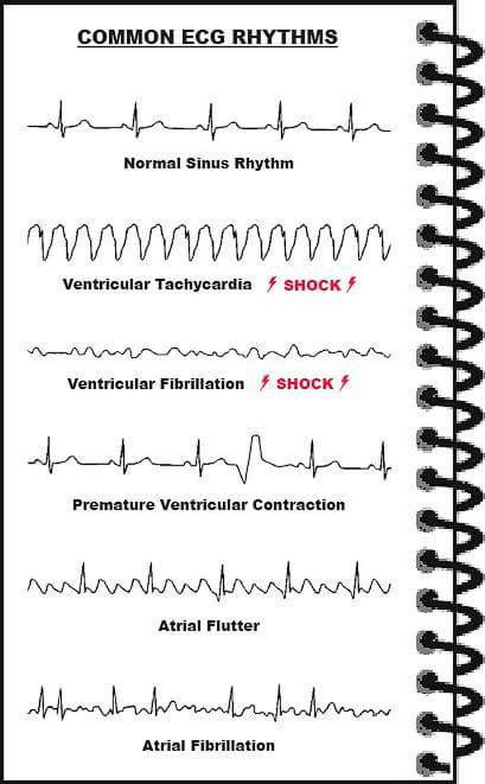 A normal ECG is illustrated above. Note that the heart is beating in a regular sinus rhythm between 60 - 100 beats per minute (specifically 82 bpm). All the important intervals on this recording are within normal ranges.

1.  P wave:

upright in leads I, aVF and V3 - V6

normal duration of less than or equal to 0.11 seconds

polarity is positive in leads I, II, aVF and V4 - V6; diphasic in leads V1 and V3; negative in aVR

shape is generally smooth, not notched or peaked

2. PR interval:

 Normally between 0.12 and 0.20 seconds.

3. QRS complex:

Duration less than or equal to 0.12 seconds, amplitude greater than 0.5 mV in at least one standard lead, and greater than 1.0 mV in at least one precordial lead. Upper limit of normal amplitude is 2.5 - 3.0 mV.

small septal Q waves in I, aVL, V5 and V6 (duration less than or equal to 0.04 seconds; amplitude less than 1/3 of the amplitude of the R wave in the same lead).

represented by a positive deflection with a large, upright R in leads I, II, V4 - V6 and a negative deflection with a large, deep S in aVR, V1 and V2

in general, proceeding from V1 to V6, the R waves get taller while the S waves get smaller. At V3 or V4, these waves are usually equal. This is called the transitional zone.

4. ST segment:

isoelectric, slanting upwards to the T wave in the normal ECG

can be slightly elevated (up to 2.0 mm in some precordial leads)

never normally depressed greater than 0.5 mm in any lead

5. T wave:

T wave deflection should be in the same direction as the QRS complex in at least 5 of the 6 limb leads

normally rounded and asymmetrical, with a more gradual ascent than descent

should be upright in leads V2 - V6, inverted in aVR

amplitude of at least 0.2 mV in leads V3 and V4 and at least 0.1 mV in leads V5 and V6

isolated T wave inversion in an asymptomatic adult is generally a normal variant

6. QT interval:

 Durations normally less than or equal to 0.40 seconds for males and 0.44 seconds for females.