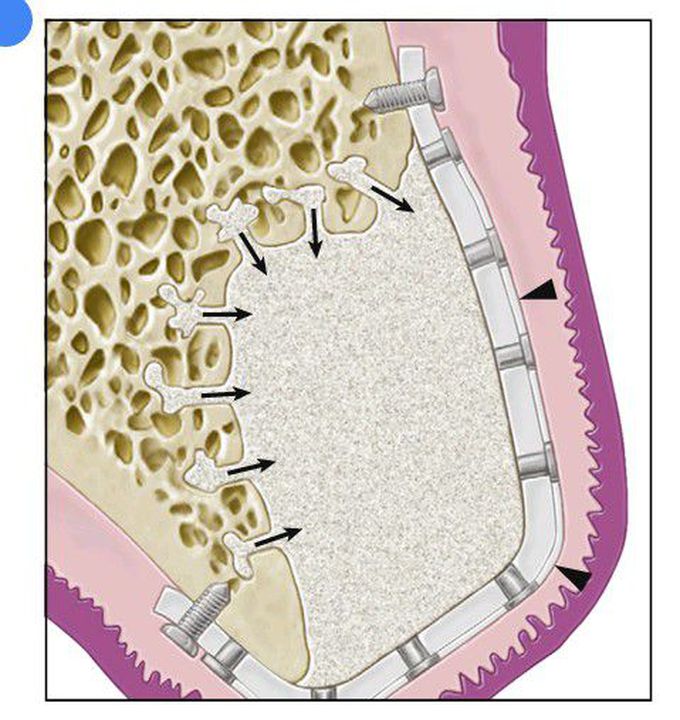 Guided bone regeneration (GBR).