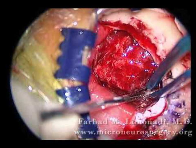 Left Suboccipital Craniotomy and removal of brain tumor (brain surgery)
