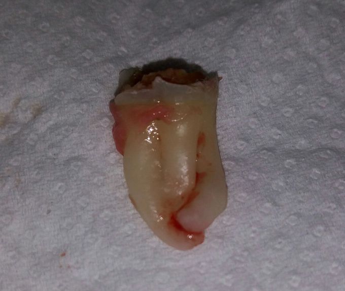 This kind of teeth is called??