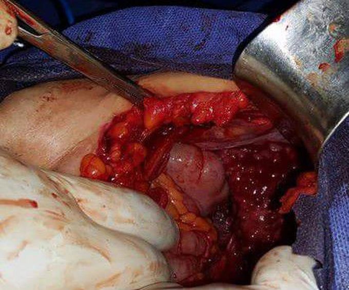 Cirrhotic liver