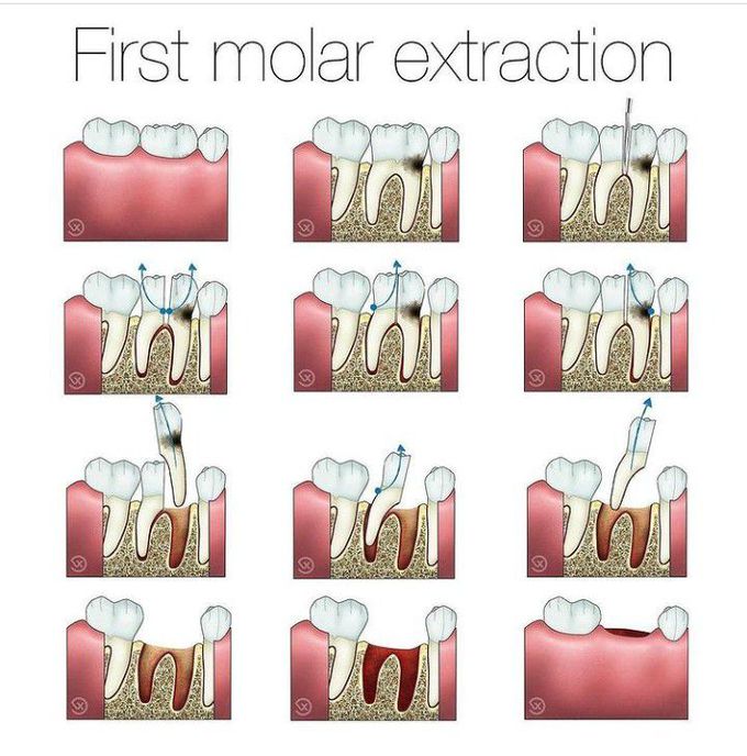 first-molar-extraction-medizzy