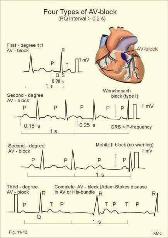 Types of AV block - MEDizzy