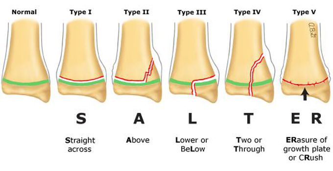 Salter-Harris Classification of Growth Plate Fractures