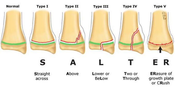 Salter-Harris Classification of Growth Plate Fractures