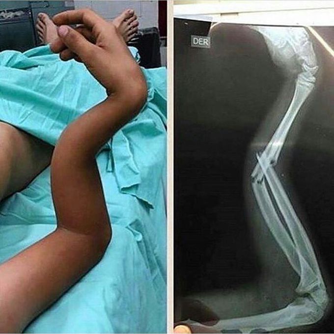 Fractured forearm!!