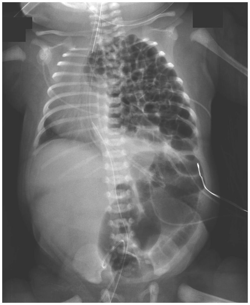 Congenital Diaphragmatic Hernia - MEDizzy