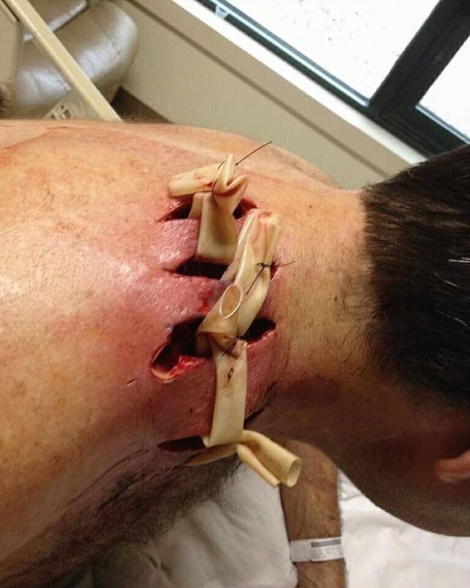 Recluse spider bite