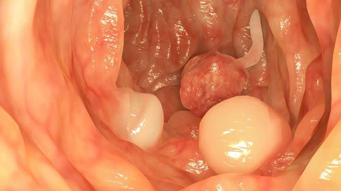 Bowel Polyps Symptoms