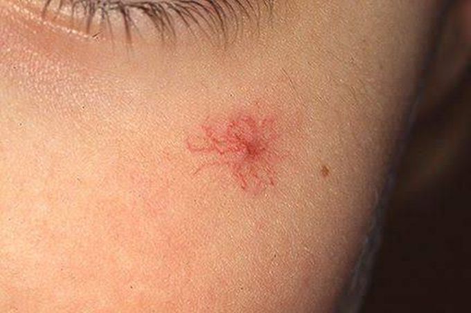 Spider angioma