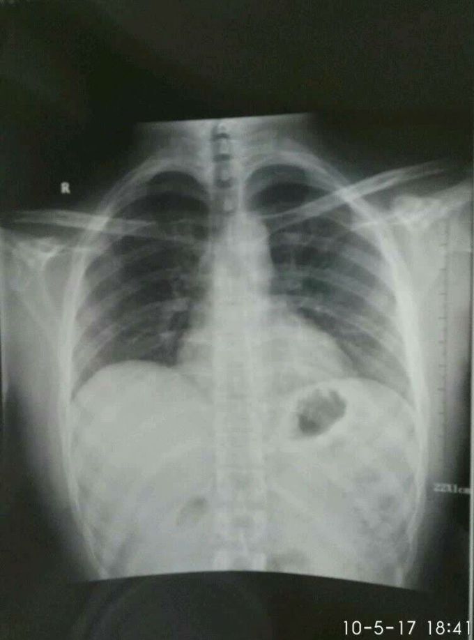 Is this cxr normal ?