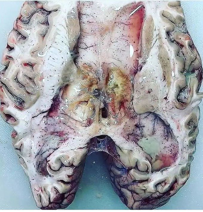 Bacterial Meningitis