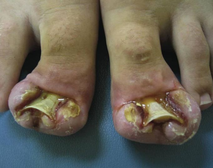 This is an extreme case of ingrown toenails! Have you ever had anything like this?