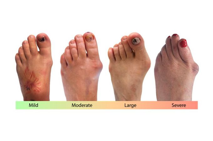 Complications of bunion