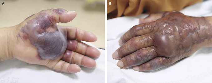Vibrio vulnificus Infection