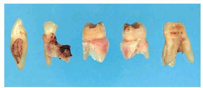 Extraction complications