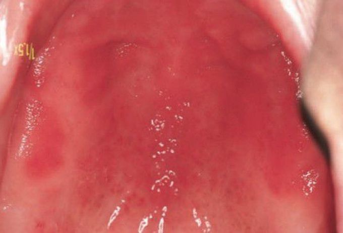 Acute erythmatous candidiasis