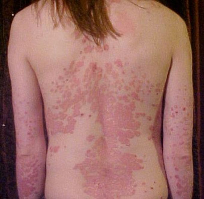 Symptoms of psoriasis